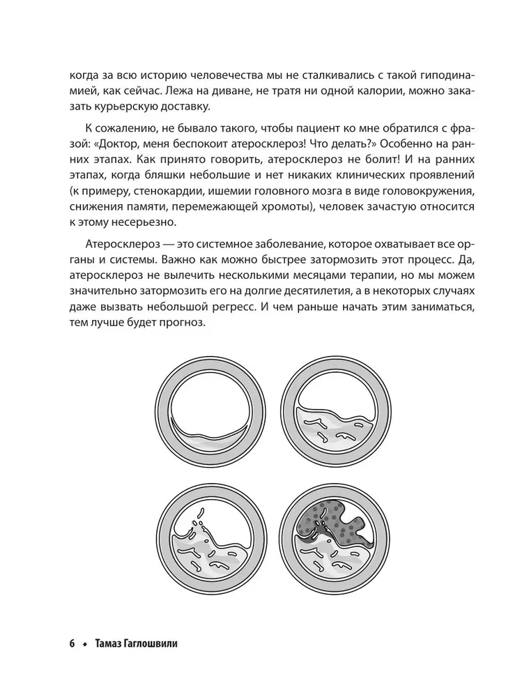 Ateroskleroze. Viss par ārstēšanu, diētu un asinsvadu veselības uzturēšanu